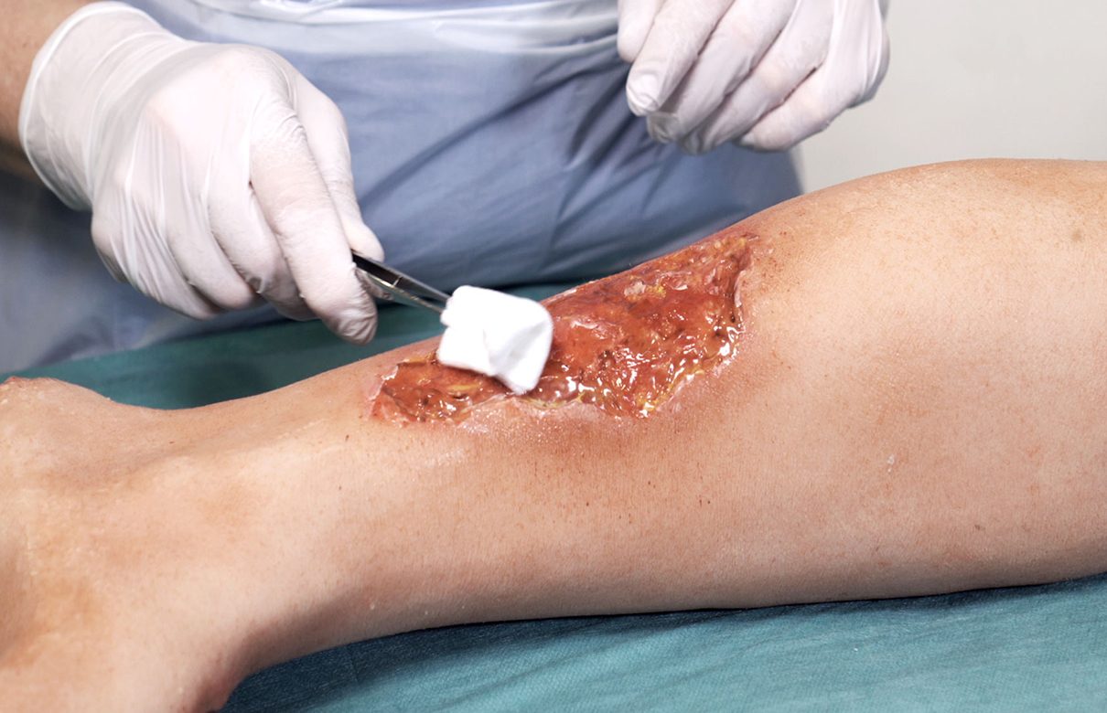 Sjukvårdspersonal rengör ett större bensår.