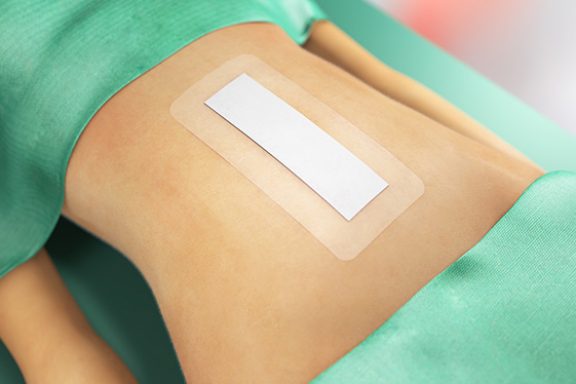 Sorbact-förband på kirurgiskt snitt på magen.