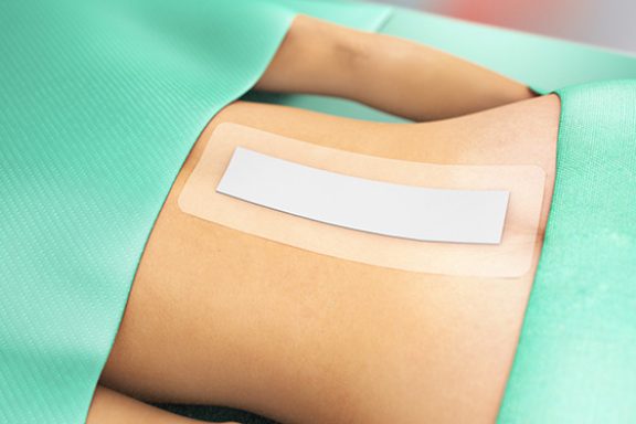 Sorbact-förband på ryggen efter kirurgiskt ingrepp.