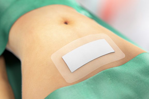 Sorbact-förband över buken efter kejsarsnitt.