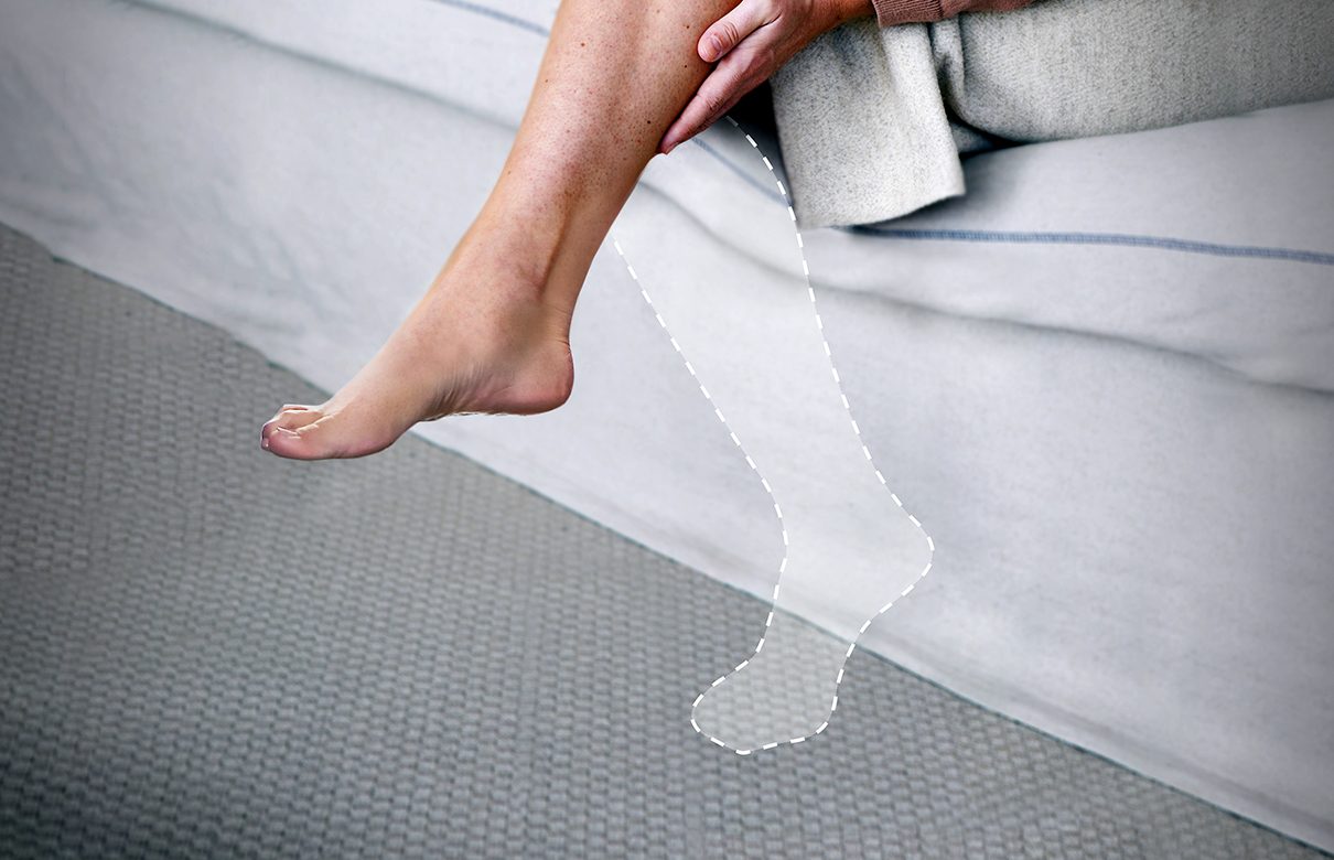 Ett ben med markerad kontur av en amputerad fot.
