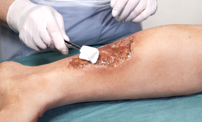A nurse cleaning an infected wound on a leg