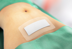 An abdomen in a postoperative environment with a Sorbact Surgical dressing applied on it